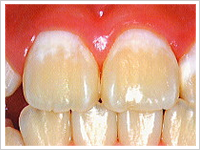フッ素は虫歯予防にどう効くの？ 