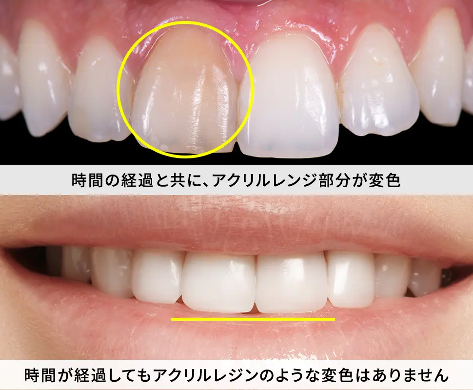 保険適用材料と「セラミック」の違い