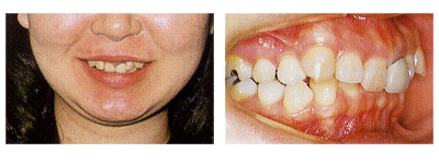 悪い歯並びの種類
