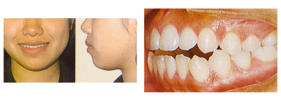 悪い歯並びの種類