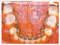 歯の状態によって使うものが異なる矯正装置