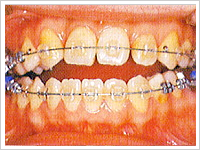 歯の状態によって使うものが異なる矯正装置