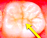 歯の溝の封鎖による虫歯予防(シーラント)